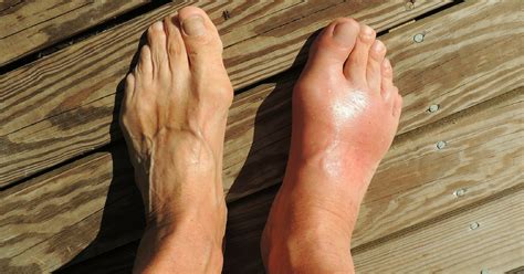 8 Reasons Why Your Health Maybe In Danger If You Have Swollen Feet