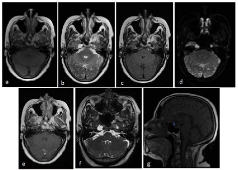 Mri Images In Axial Plan In T1 Weighted Fse A T2 Weighted Fse B