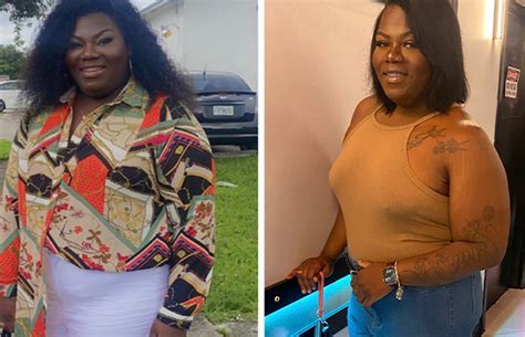 Weight Loss Surgery Helps A Miami Woman Lose Weight And Prepare For