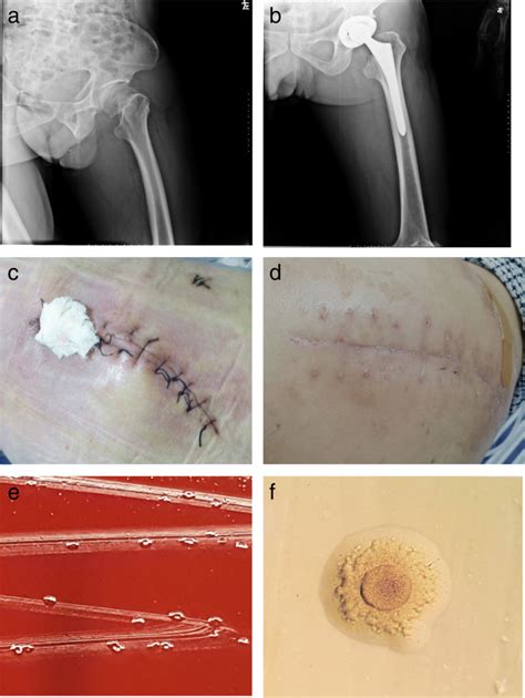 Infection Due To Mycoplasma Hominis After Left Hip Replacement Case