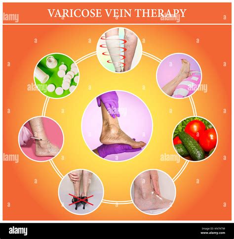 Treatment Of Varicose Veins Stock Photo Alamy