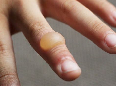 Burn Blister First Aid Treatment And Types Of Burns
