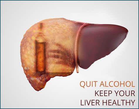Alcoholic Liver Disease Alcohol Related Liver Disease Treatment