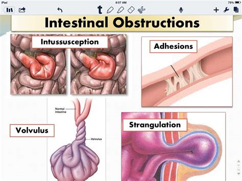 Types Of Intestinal Obstructions Vulvulus Is Twisted And Rare Adhesions Are From Scar Tissue