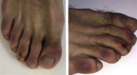 Covid Toes Scientists Discover Red And Swollen Feet As New Symptom