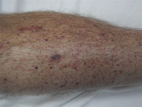 Skin Cancer Rash Symptoms Idaman