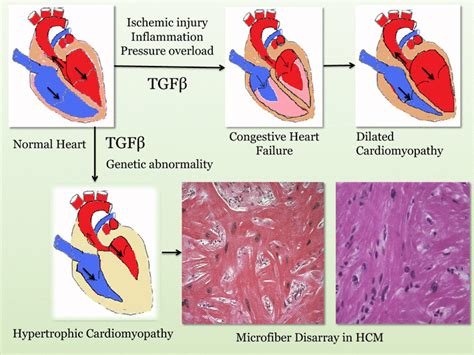 Pathogenesis Of Cardiomyopathy Pressure Overload Inflammation Or