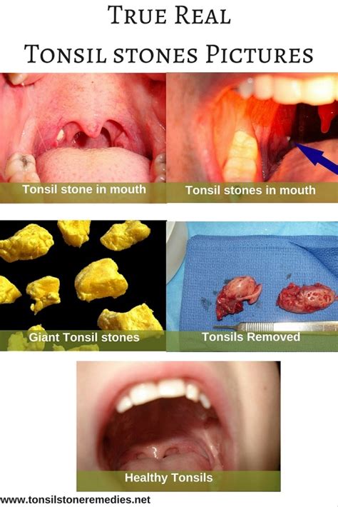 Watch The True Clear Pictures Of Tonsil Stones