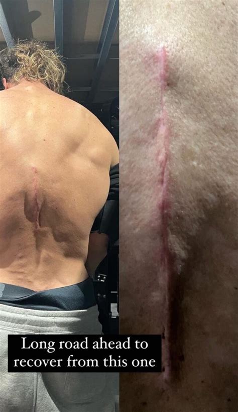 Calum Von Moger Finally Reveals His Injuries IronMag Bodybuilding