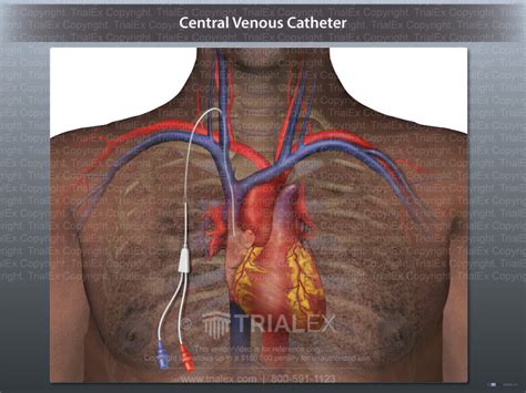 Central Venous Catheter Trial Exhibits Inc