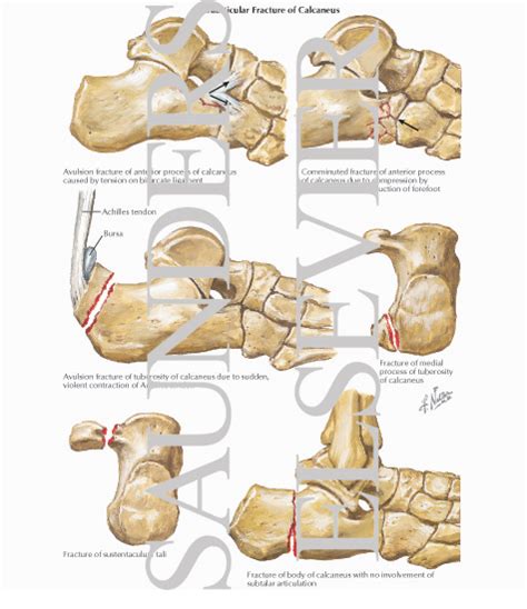Calcaneus Heel Bone