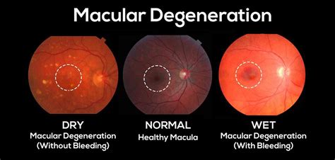 What Is Macular Degeneration Rieleyes