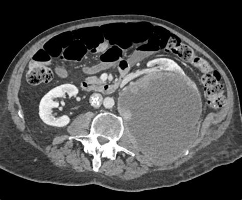 Cystic Left Renal Cell Carcinoma Kidney Case Studies Ctisus Ct Scanning
