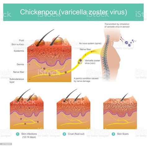 Chickenpox Varicella Zoster Virus Stock Illustration Download Image