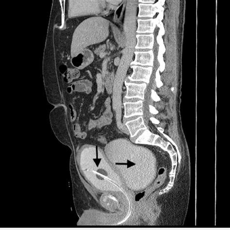 Sagittal View Of Ct Abdomen And Pelvis With Contrast Showing A Large