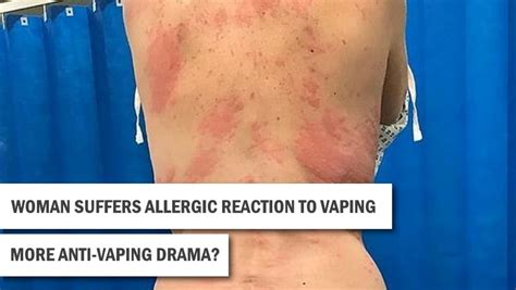 Mother Suffers An Allergic Reaction To Vaping Motivape