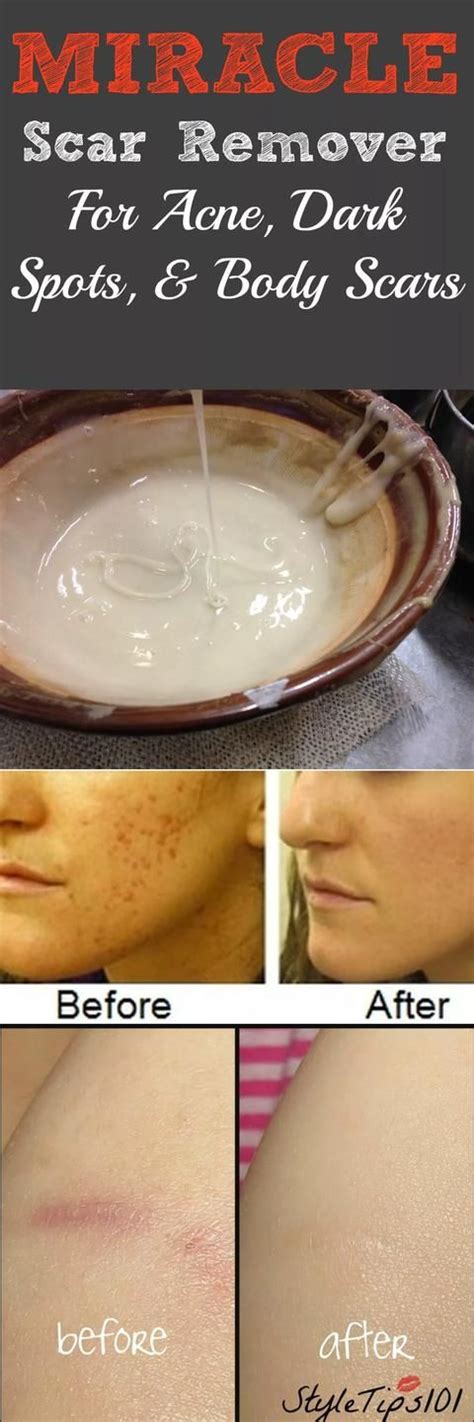 The Best Homemade Scar Remover For Acne And Dark Spots Acne Dark