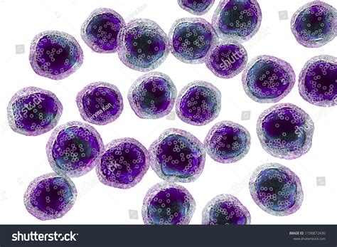 Burkitts Lymphoma Cells Cancer Lymphatic System Stock Illustration