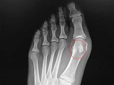 Sesamoid Fractures Causes Symptoms And Treatment