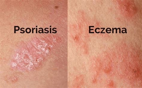 Treatment For Eczema • Best Homeopathy Treatment In 2022