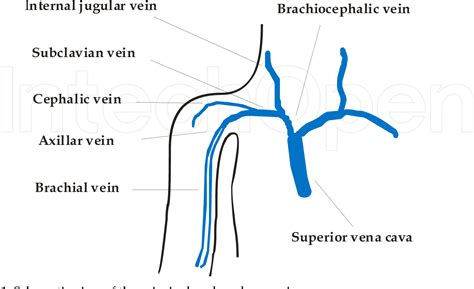 Figure 4 From I Nternal Jugular Vein Subclavian Vein Brachial Vein