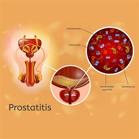 Types Of Prostate Disease Causes And Symptoms