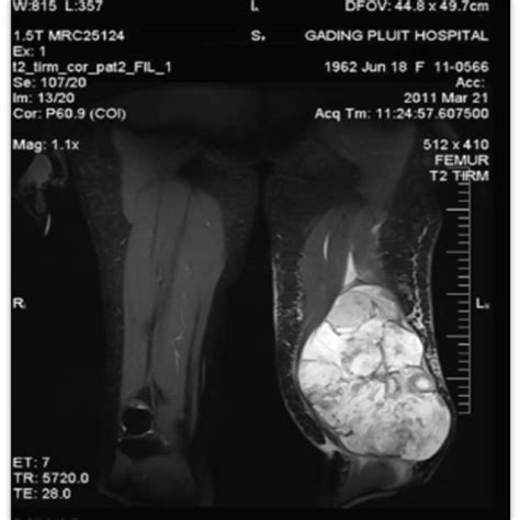 Mri Examination Of The Large Mass On The Left Thigh After Two Taci