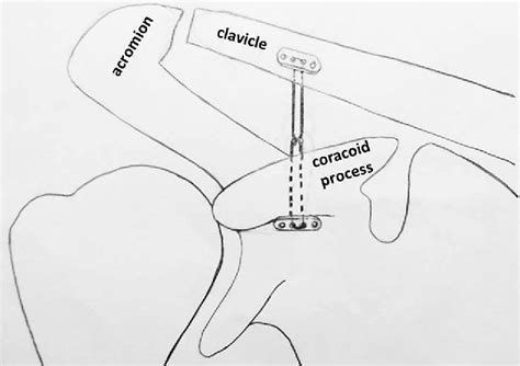 Pdf Endobutton Technique For The Treatment Of Acute Acromioclavicular