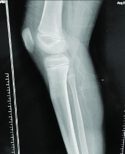 X Ray Showing Swelling In The Calf Region Download Scientific Diagram