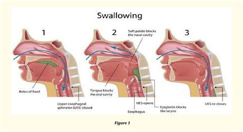 Figure 1 From Functional Outcome Measurements In Acute Stroke Patients With Oropharyngeal