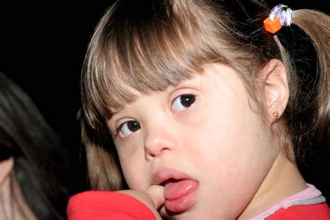 Discapacidad Y Salud Tratamiento Del Menor Con Síndrome De Down