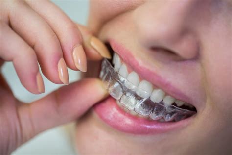 Invisalign Braces Tips On Taking Care Of Your Aligners