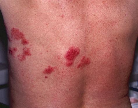Shingles Rash Mild Early Stages Pictures Ehealthstar