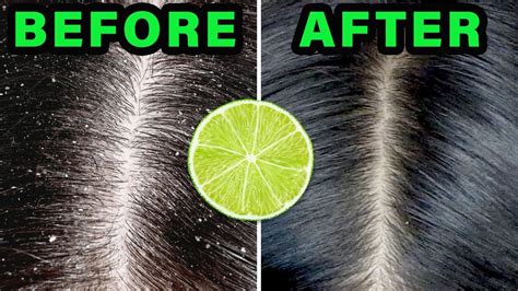 In this article, we talk about how to use lime juice for dandruff and what else you should know about it. Remove dandruff naturally using lemon juice | Haircare - YouTube