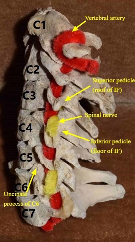 Cervical Fracture Human Spine Vertebrae Damage Outline Diagram Labeled