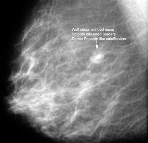 What Is The Classical Appearance Of Cyst On Mammography