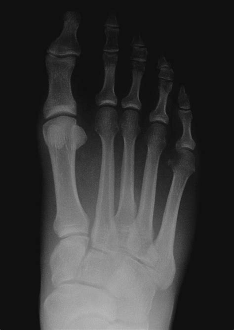 Stress Fractures In Runners Elite Foot And Ankle Center