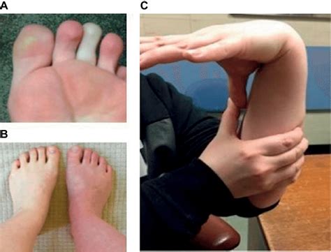 Common Clinical Signs Notes A Raynauds Phenomenon B Download Scientific Diagram