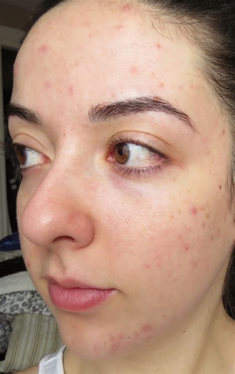 My Skins Journey Week 1 Banish Acne Scars