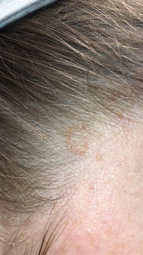 is this ringworm i have red itchy circles all over my scalp that flake when i touch them anti