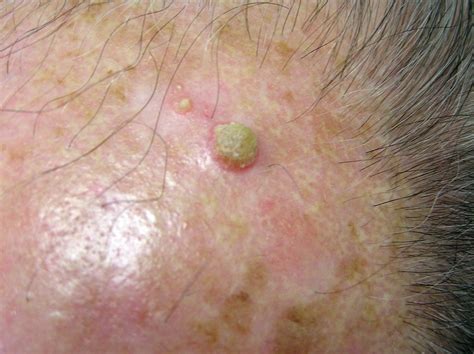 Actinic Keratosis Pictures