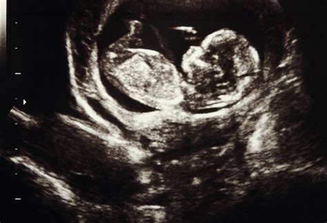 Third Trimester Scan During Pregnancy Procedure Tests And More