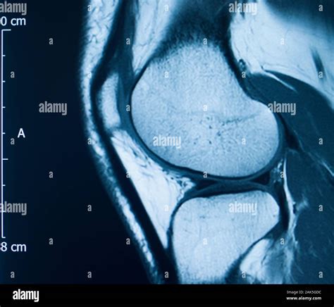 Knee Sports Injury Mri Mcl Grade Tear Magnetic Resonance Imaging Orthopedic Traumatology Scan