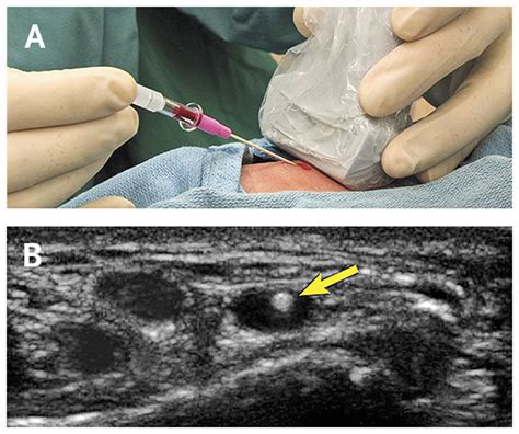 Ultrasound Guided Insertion Of A Radial Arterial Catheter Nejm