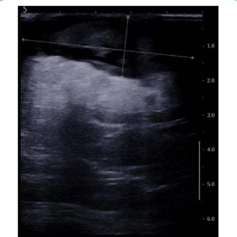 An Ultrasound Image Of The Left Breastthe Dotted Lines Mark The