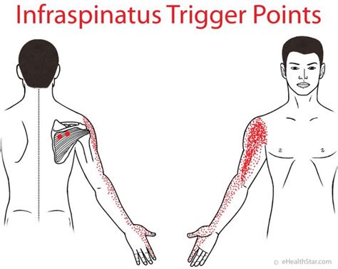 Infraspinatus Trigger Points Pain And Tear Test Exercises Ehealthstar