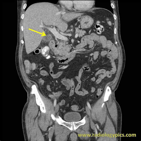 Gallbladder Radiologypicscom