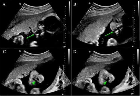 Prenatal Ultrasonographic Diagnosis Of Cleft Lip With Or Without Cleft