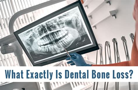 Dental Bone Loss Riverside Dental