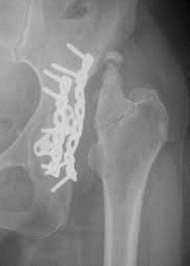 Acetabular Fractures Trauma Orthobullets